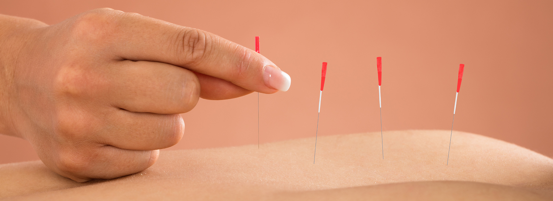 Acupuncture Cheap Near Me - Acupuncture Acupressure Points